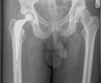 X-ray showing a Right Total Hip Replacement with a cemented highly cross-linked polyethylene cup (Reflection™), a cemented femoral stem (Exeter™)and a ceramic head